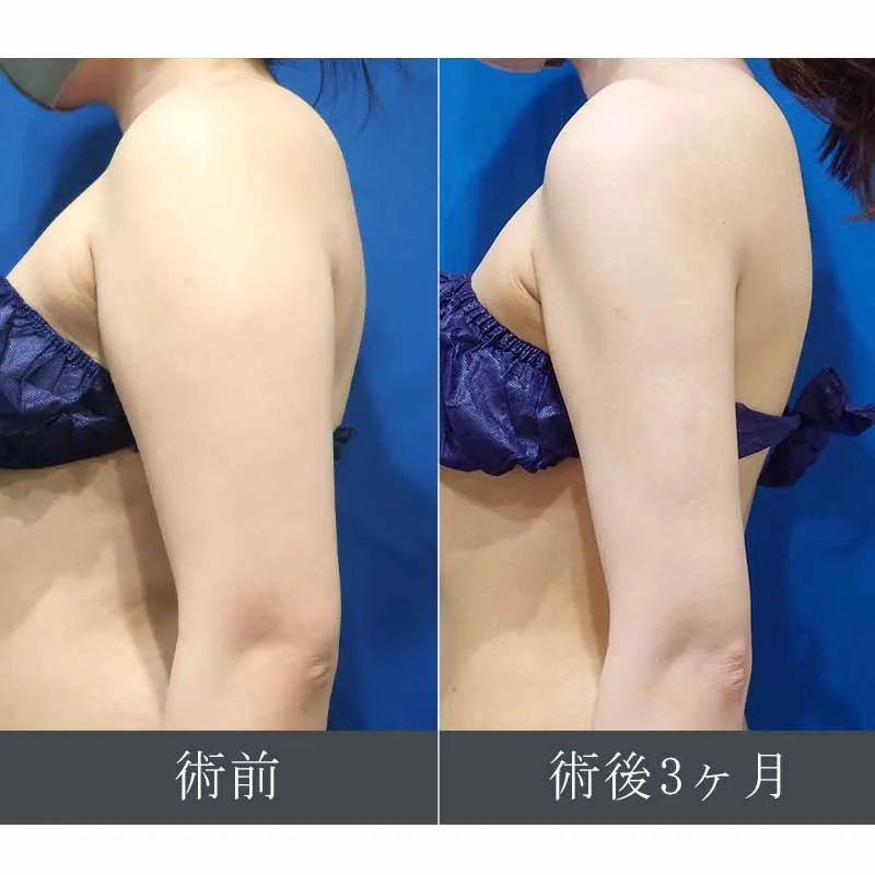 二の腕の脂肪吸引の症例写真
