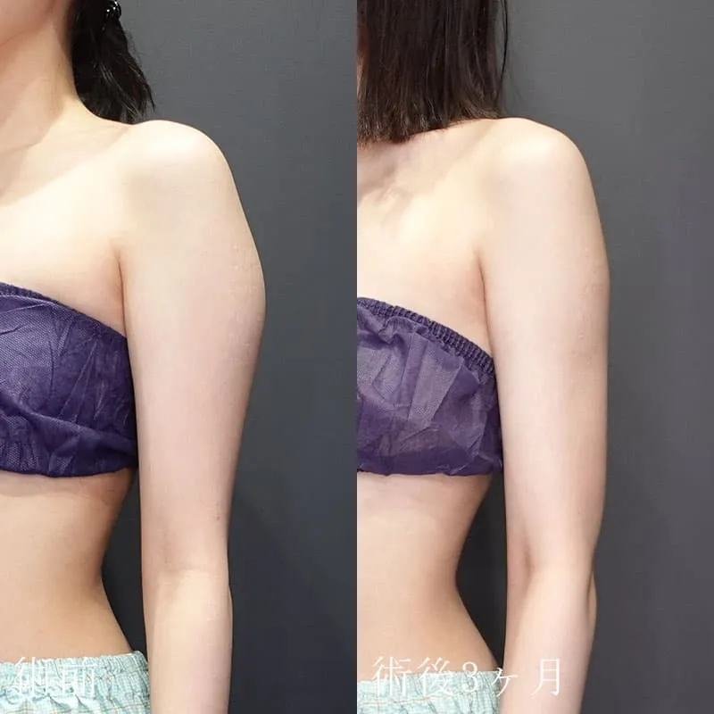 二の腕の脂肪吸引の症例写真