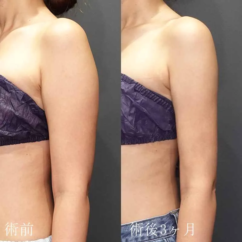 二の腕の脂肪吸引の症例写真