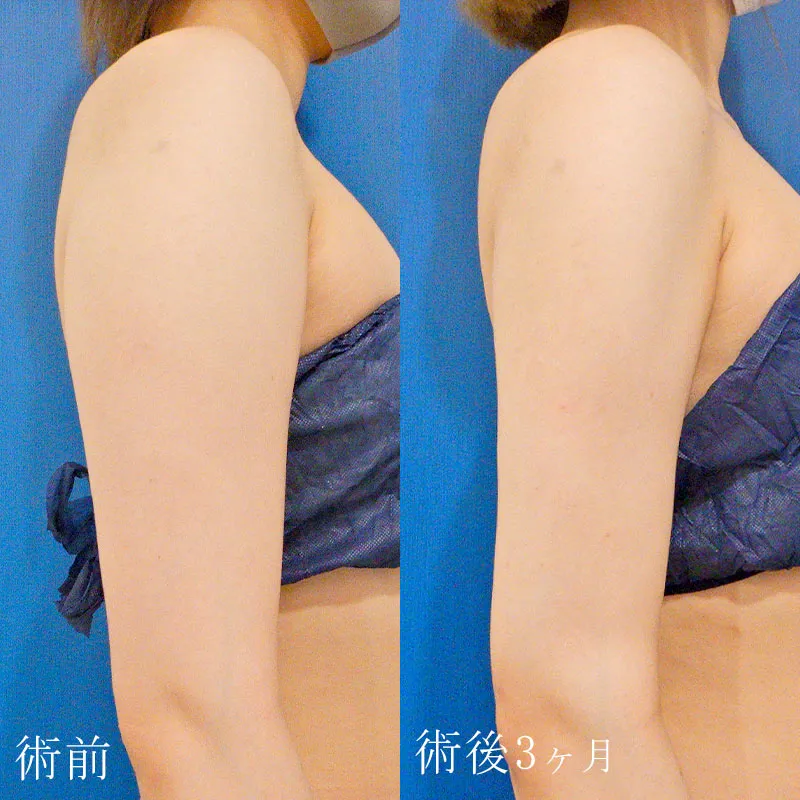二の腕の脂肪吸引の症例写真