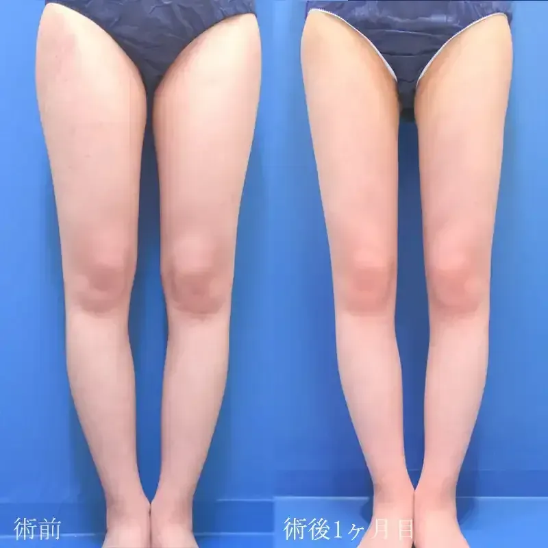 太もも・お尻の脂肪吸引の症例写真
