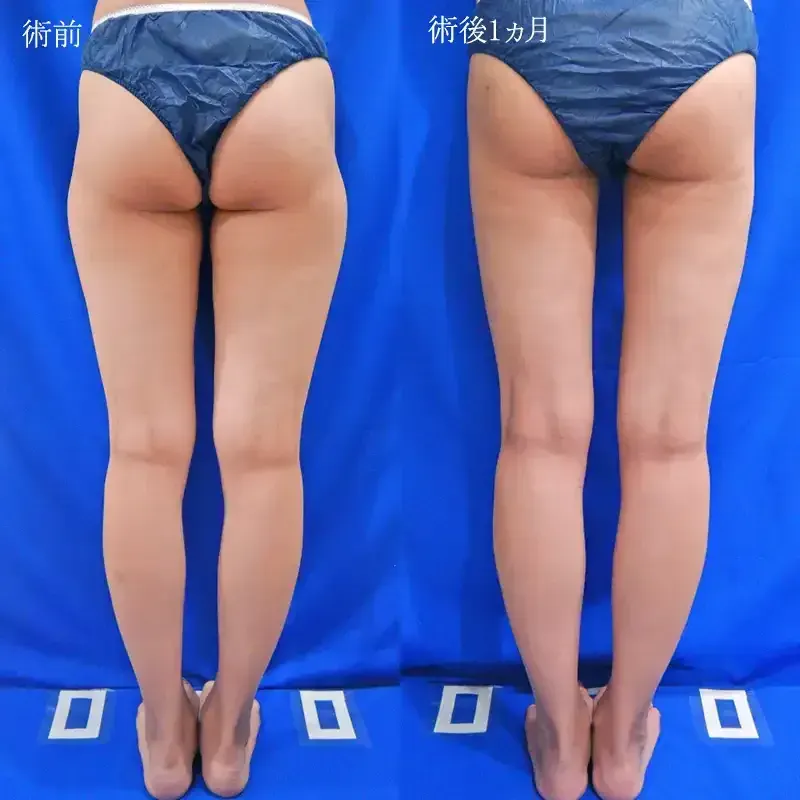 太もも・お尻の脂肪吸引の症例写真