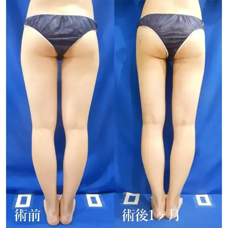 太もも・お尻の脂肪吸引の症例写真