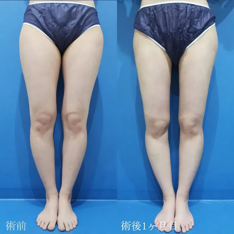 太もも・お尻の脂肪吸引の症例写真