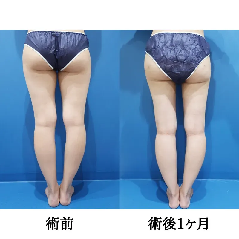 太もも・お尻の脂肪吸引の症例写真