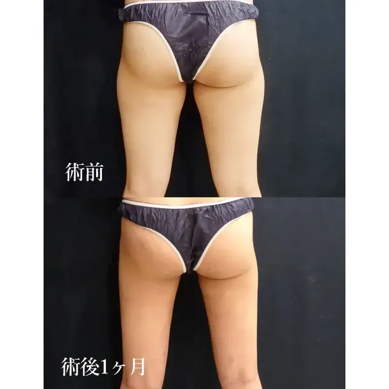 太もも・お尻の脂肪吸引の症例写真