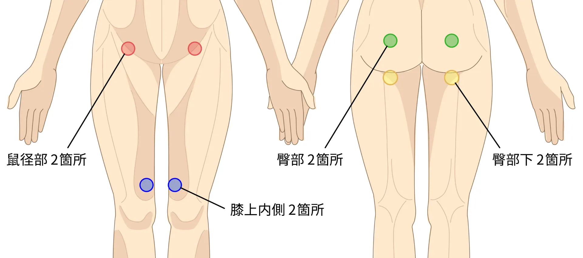 太もも・お尻の脂肪吸引の傷口の位置