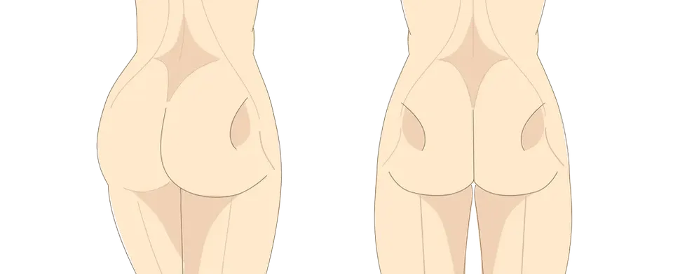 お尻の横がへこんでしまう