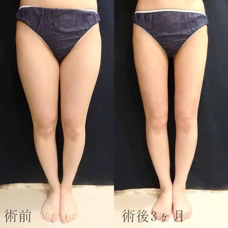 脂肪吸引専用 太もも・お尻圧迫ガードル がたかっ