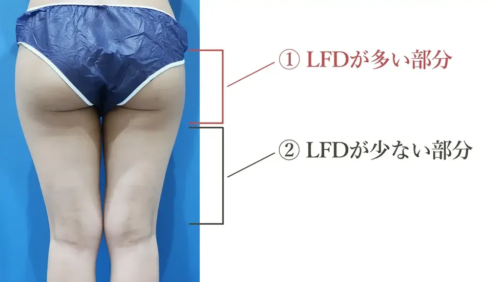 LFDが多い部分と少ない部分