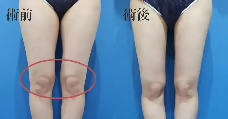 膝の脂肪吸引