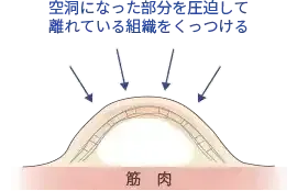 空洞を圧迫してくっつける