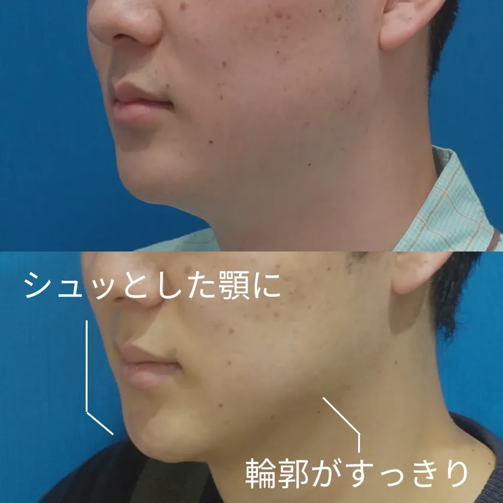 男性のお顔・顎下の脂肪吸引の症例写真②