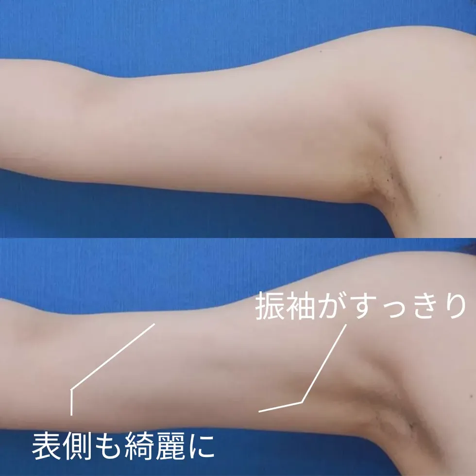 :二の腕の脂肪吸引の症例写真①-2