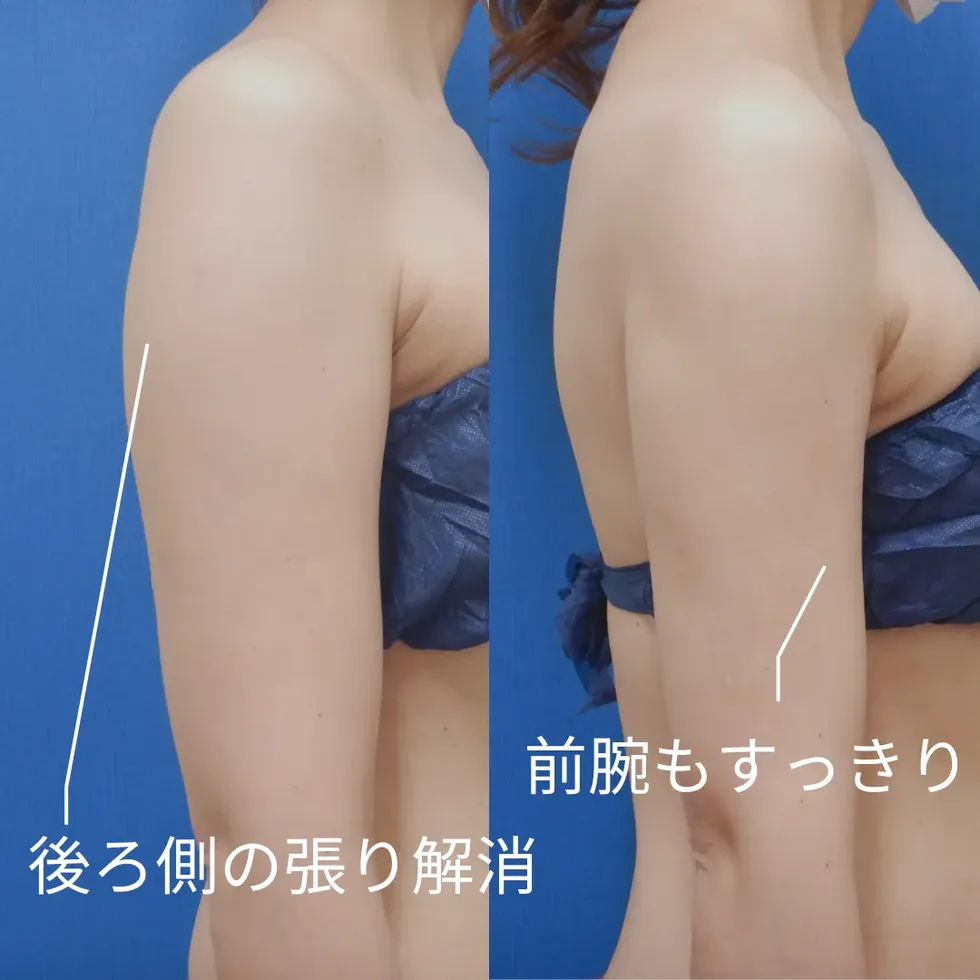 二の腕の脂肪吸引の症例写真②-2
