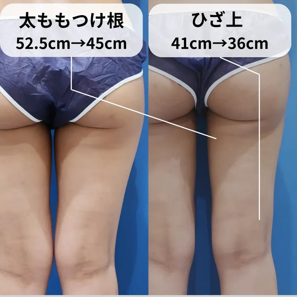 太もも・お尻の脂肪吸引の症例写真①-2