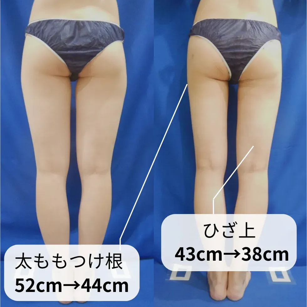 太もも・お尻の脂肪吸引の症例写真②-2