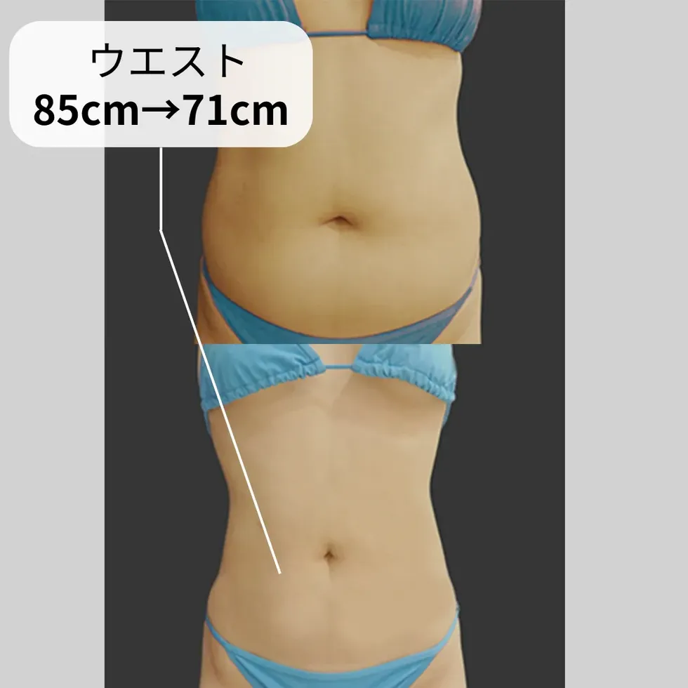 お腹・ウエストの脂肪吸引の症例写真①-2