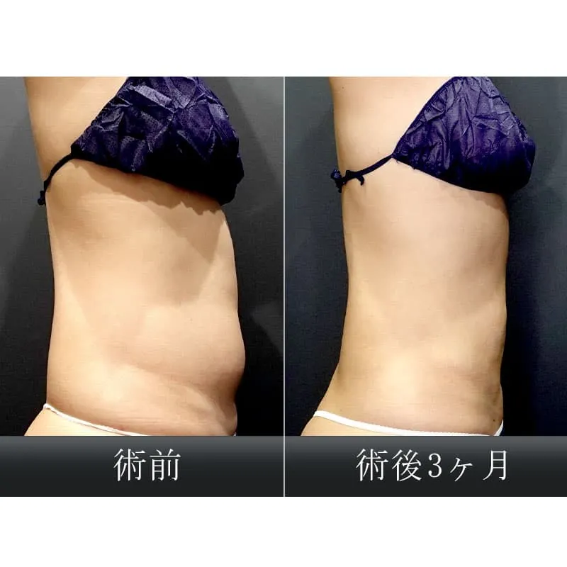 お腹・ウエストの脂肪吸引の症例写真
