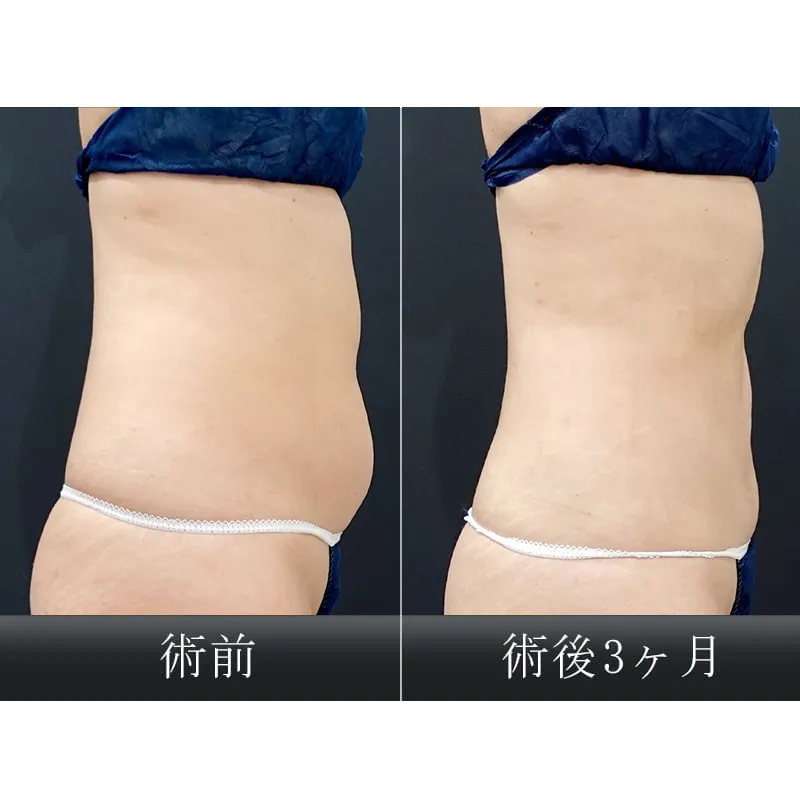 お腹・ウエストの脂肪吸引の症例写真