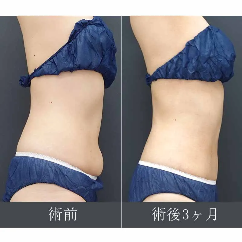 お腹・ウエストの脂肪吸引の症例写真