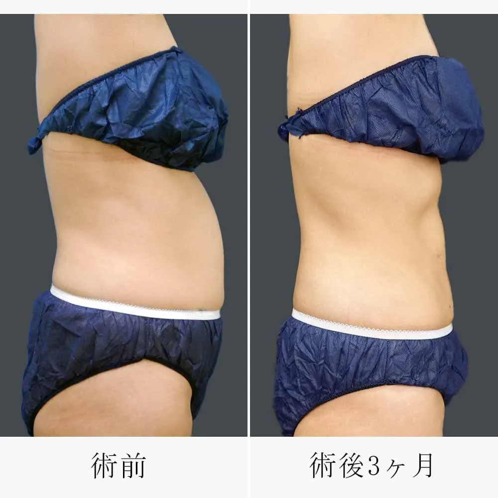 お腹・ウエストの脂肪吸引の症例写真