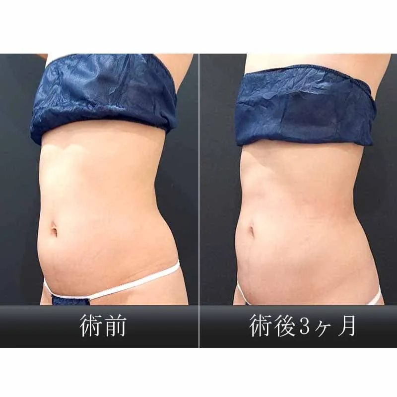 お腹・ウエストの脂肪吸引の症例写真