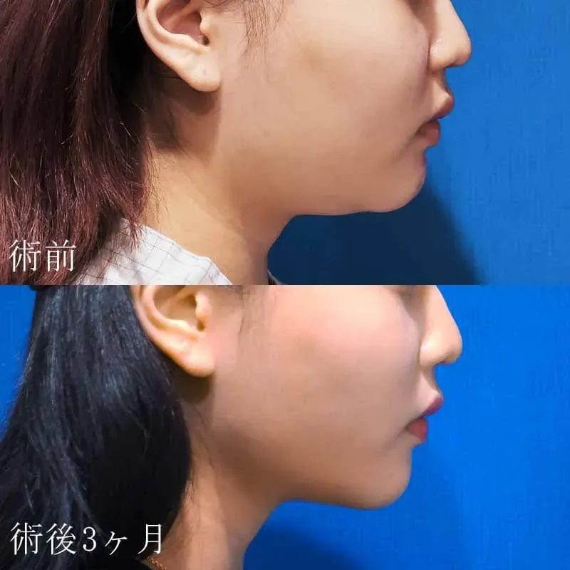 女性のお顔・顎下の脂肪吸引の症例写真①