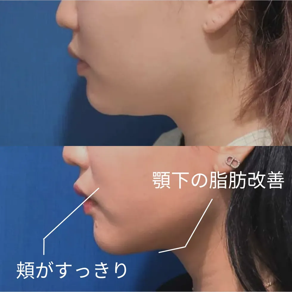 女性のお顔・顎下の脂肪吸引の症例写真②