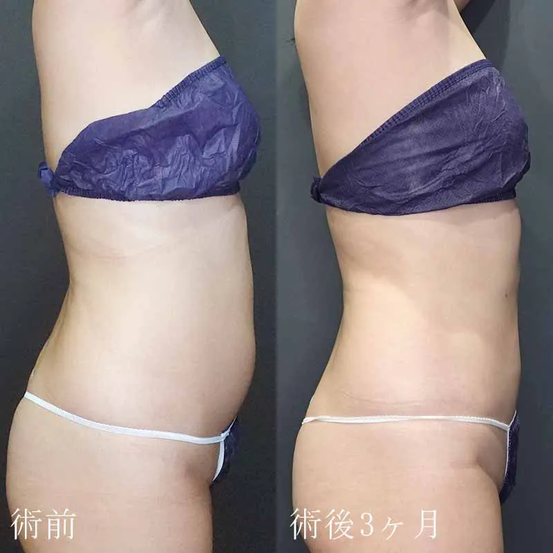 お腹・ウエスト・腰の脂肪吸引の症例写真