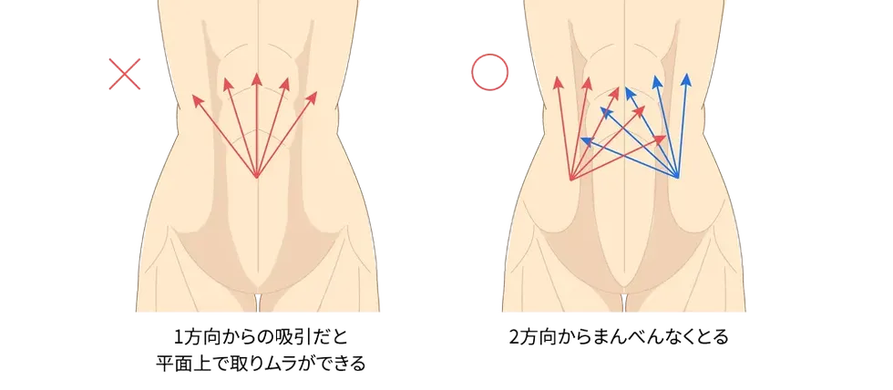 上腹部の吸引方法