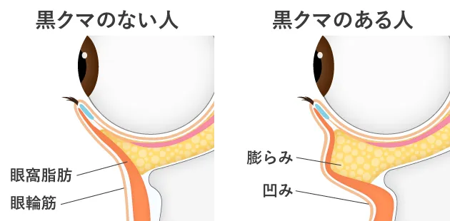 黒クマのある人と黒クマのないひと