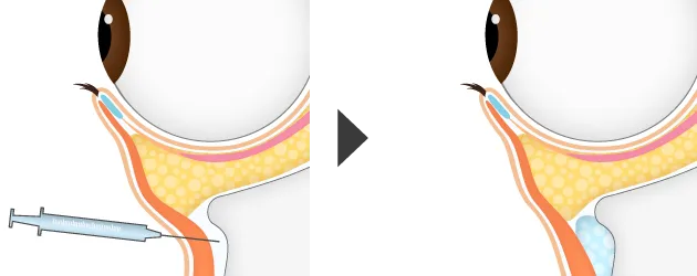 目の下のヒアルロン酸注入の注入箇所