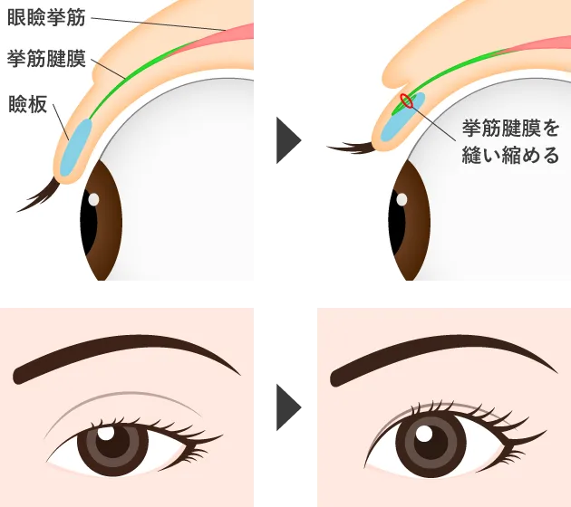 眼瞼下垂手術の仕組み