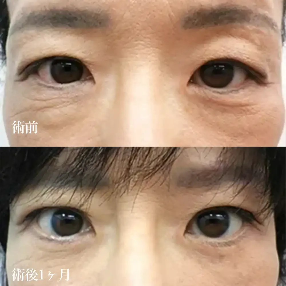 眼瞼下垂施術で目力の改善①