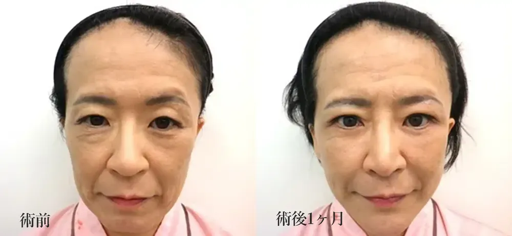 眼瞼下垂施術で目力の改善②
