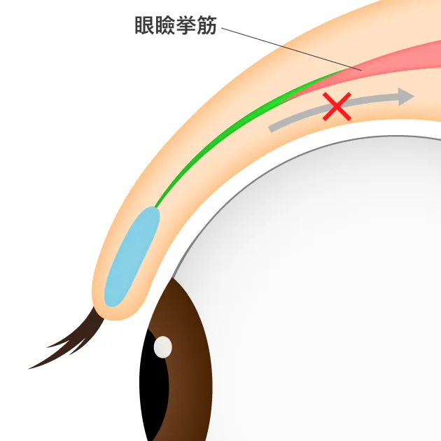 先天性眼瞼下垂