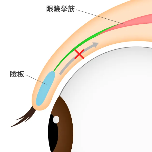 後天性眼瞼下垂