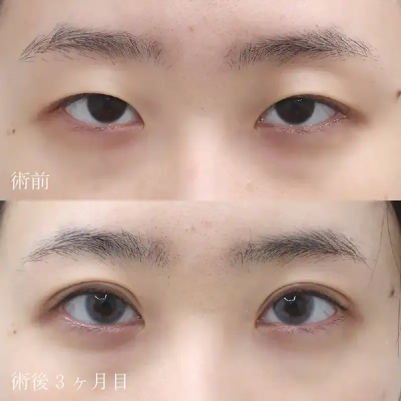 眼瞼下垂の症例写真