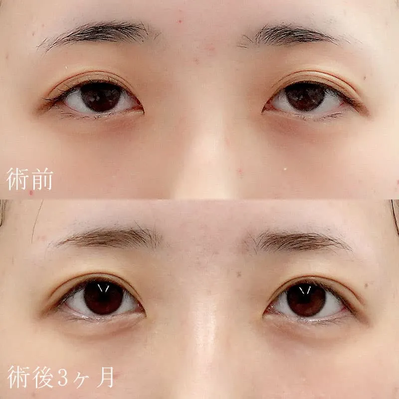 眼瞼下垂の症例写真