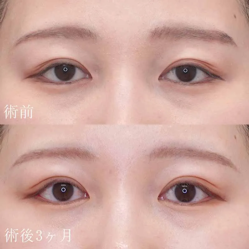 眼瞼下垂の症例写真