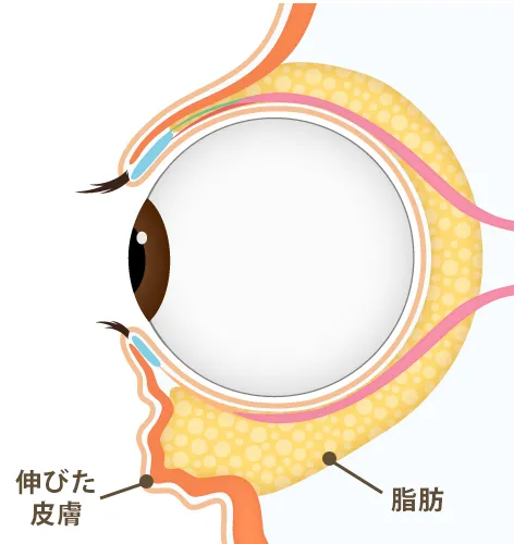 50代以上の方に多い目の下の膨らみ