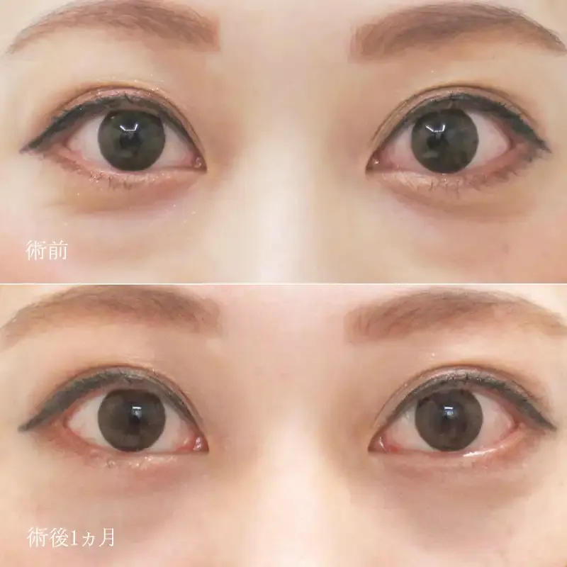 下眼瞼脱脂（目の下の脂肪取り）の症例写真②
