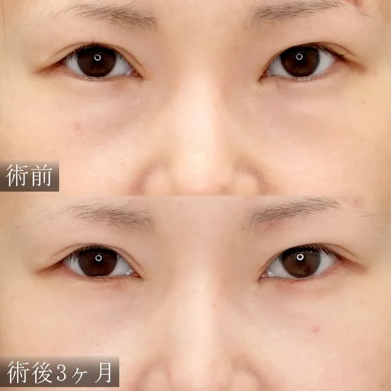 下眼瞼脱脂(目の下の脂肪取り)の症例写真①