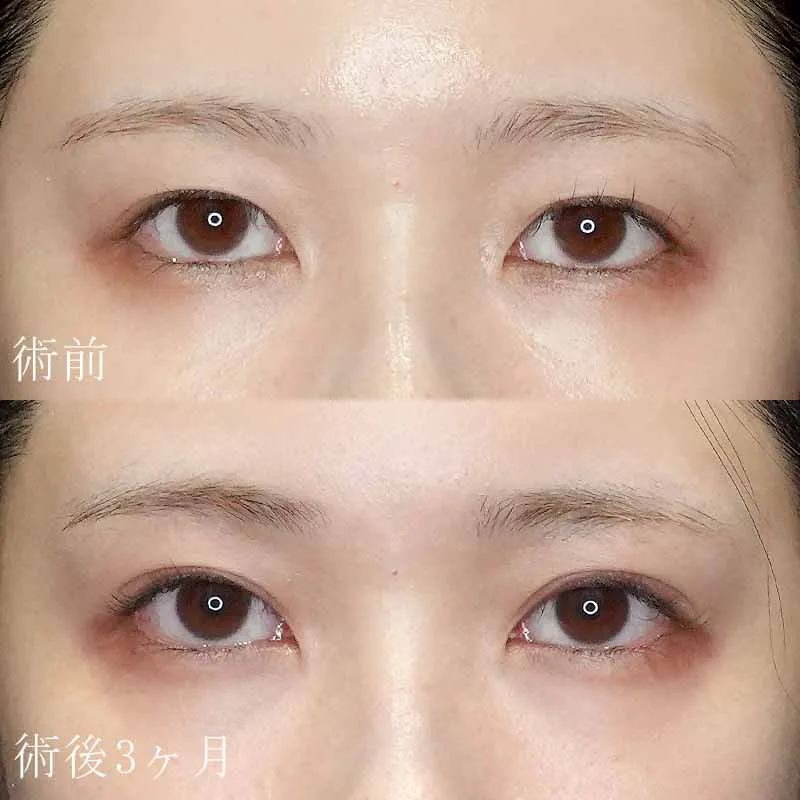 二重切開法の症例写真