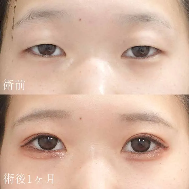 二重切開法の症例写真