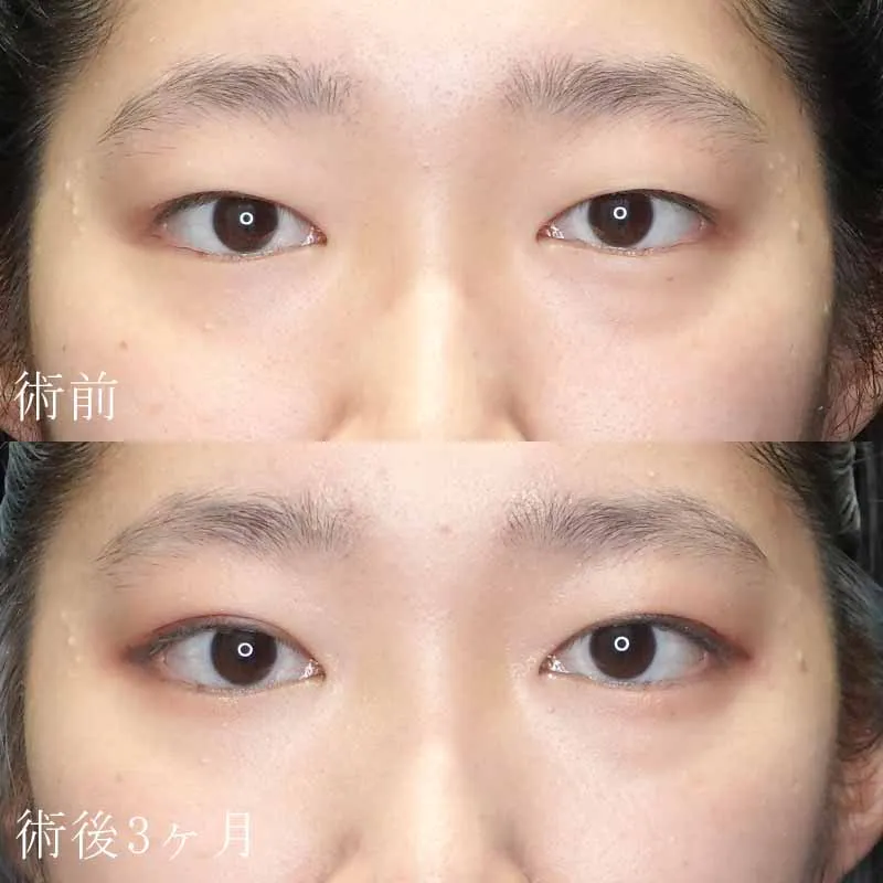 二重切開法の症例写真