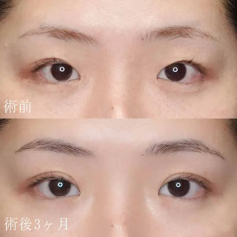 二重切開法の症例写真