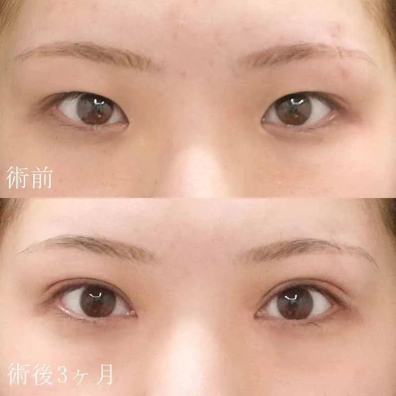 二重切開法+目頭切開の症例写真