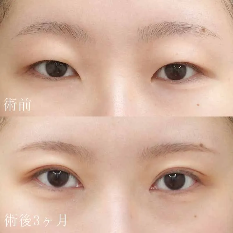 二重切開法+目頭切開の症例写真